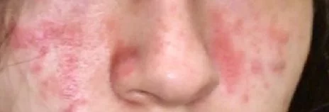 Оспамокс, антибиотик амоксицилин