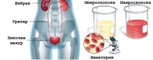 Кръв в урината, симптом