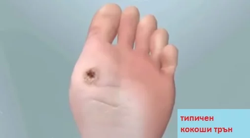 премахване на кокоши трън