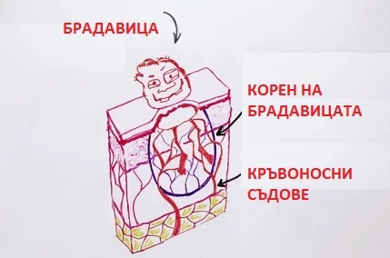 премахване на кокоши трън