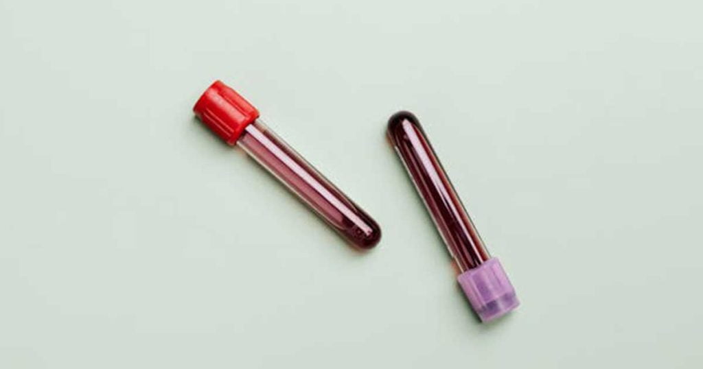 Левкемията е сложна група от ракови заболявания на кръвта, които оказват дълбоко въздействие върху развитието и функцията на белите кръвни клетки